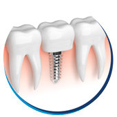 Prótese Dentária