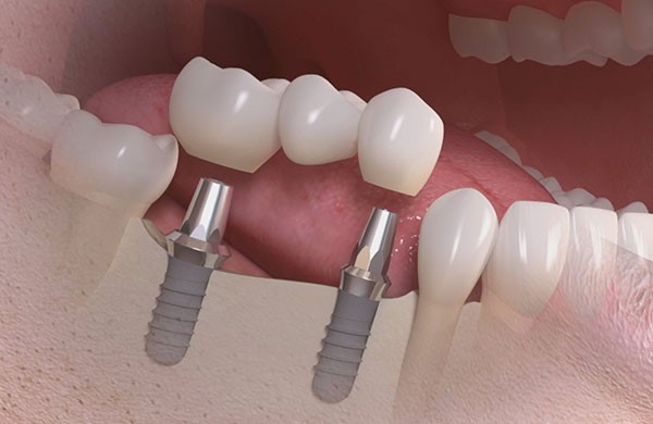 implante dentário sem corte